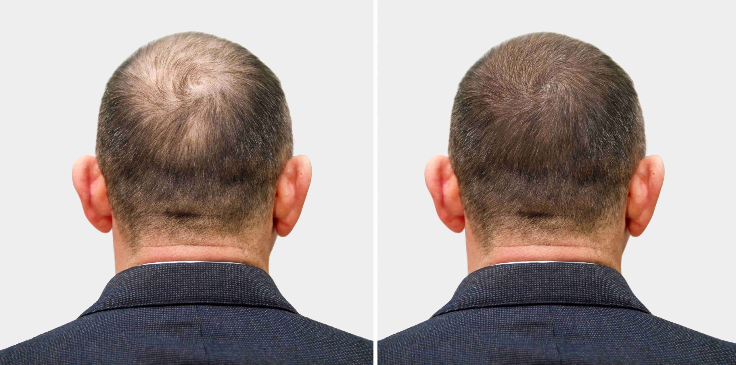 la-cabeza-de-un-hombre-calvo-antes-y-despues-de-la-cirugia-de-trasplante-de-cabello-se-ha-convertido-en-un-hombre-que-pierde-el-cabello (1) (1)